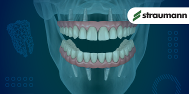 "All on Four" System by Straumann (w/fixed hybrid denture)